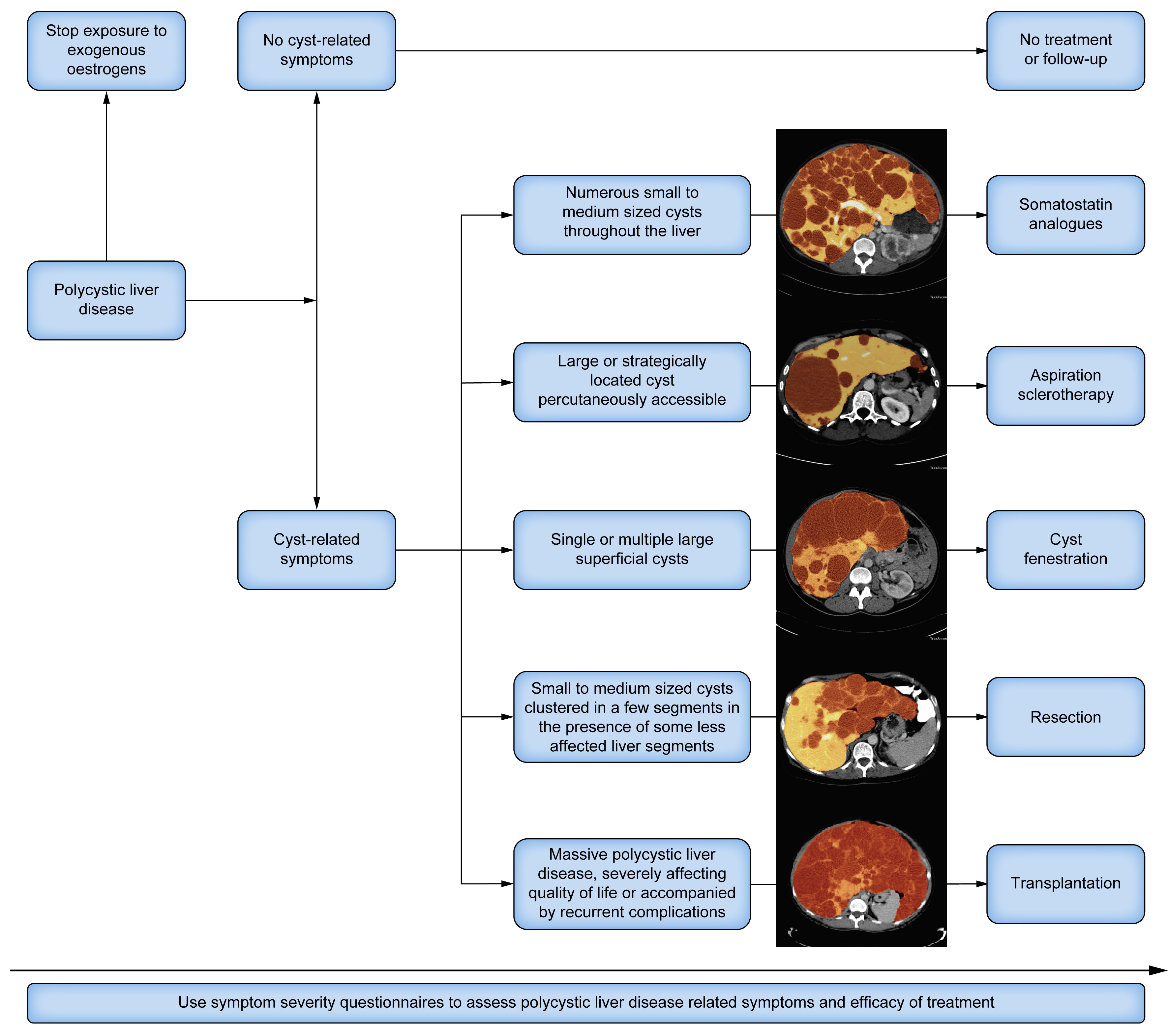 Polycystic liver disease management flowchart