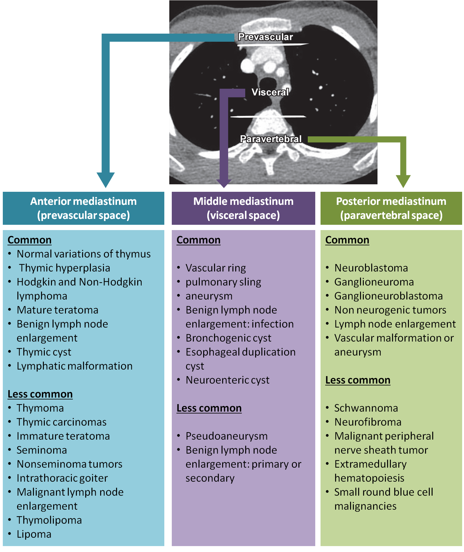 Mediastinal mass compartments and differential diagnosis