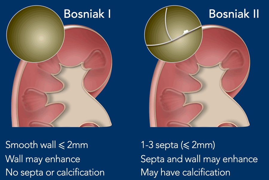 Bosniak I and Bosniak II renal cyst criteria