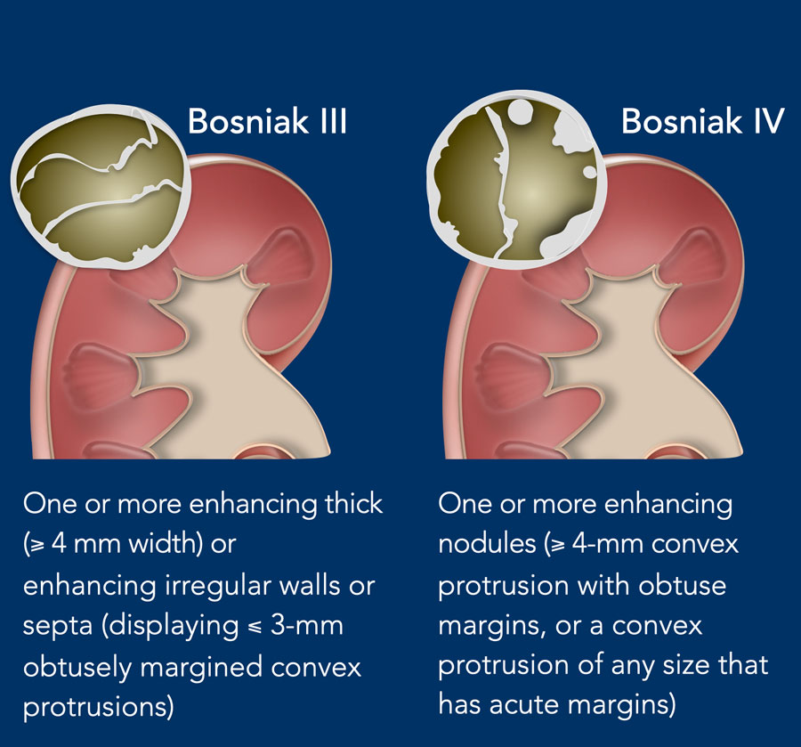 Bosniak III and Bosniak IV renal cyst criteria
