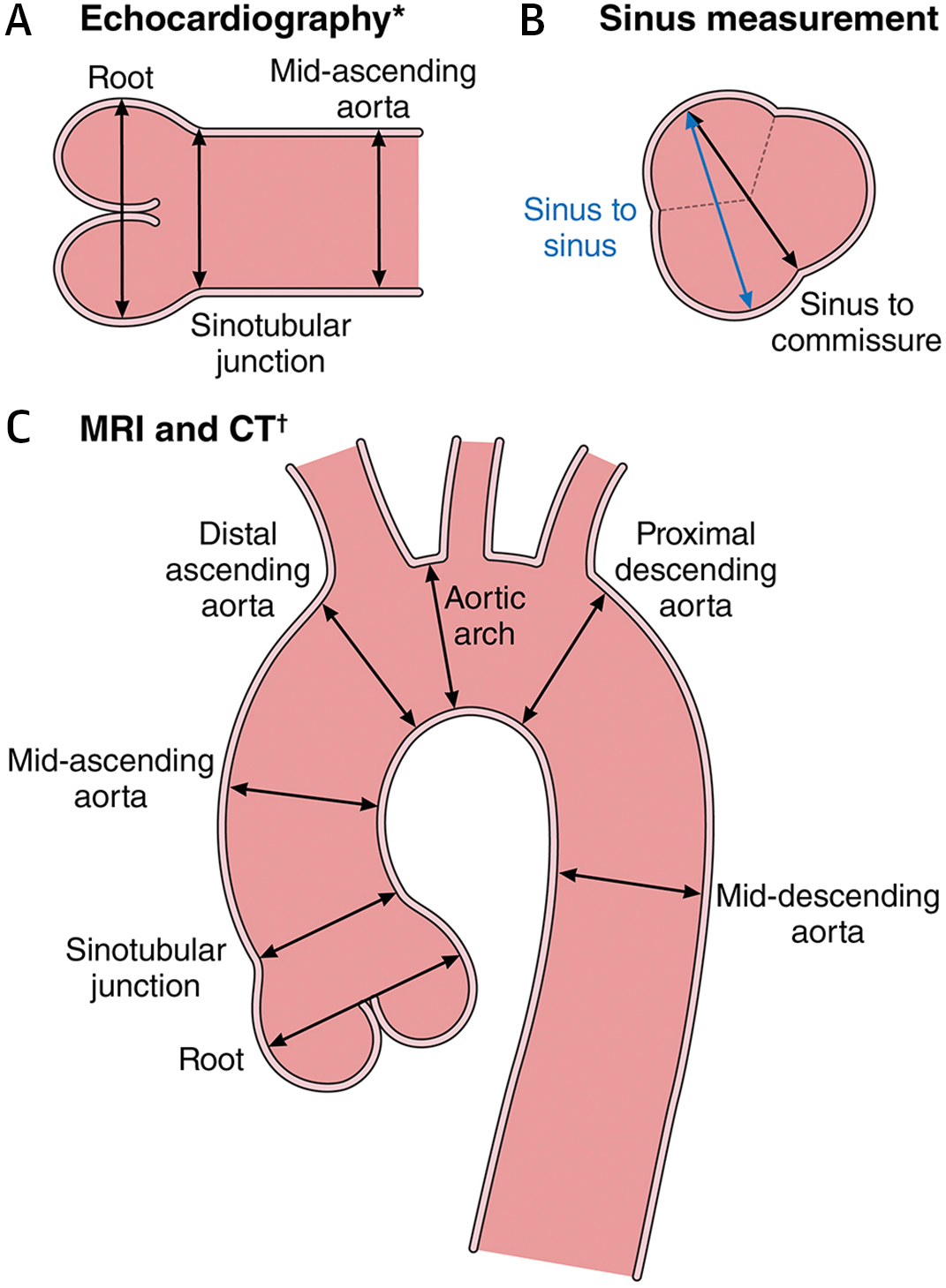Thoracic aorta measurement locations and technique