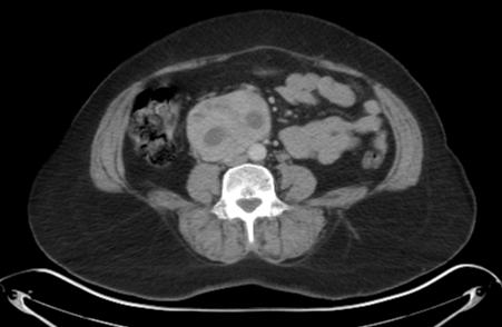 Extra-adrenal pheochromocytoma (paraganglioma)