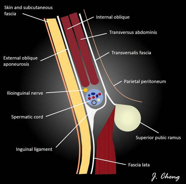 A sagittal schematic of the male inguinal canal demonstrating its boundaries and relations. 
Case Discussion

Due to its oblique course through multiple layers of fascia, the walls of the inguinal canal can be difficult to conceptualise. This diagram attempts to simplify the boundaries and structures within the canal. This diagram pertains to males; however, in females the spermatic cord will be replaced by the round ligament.