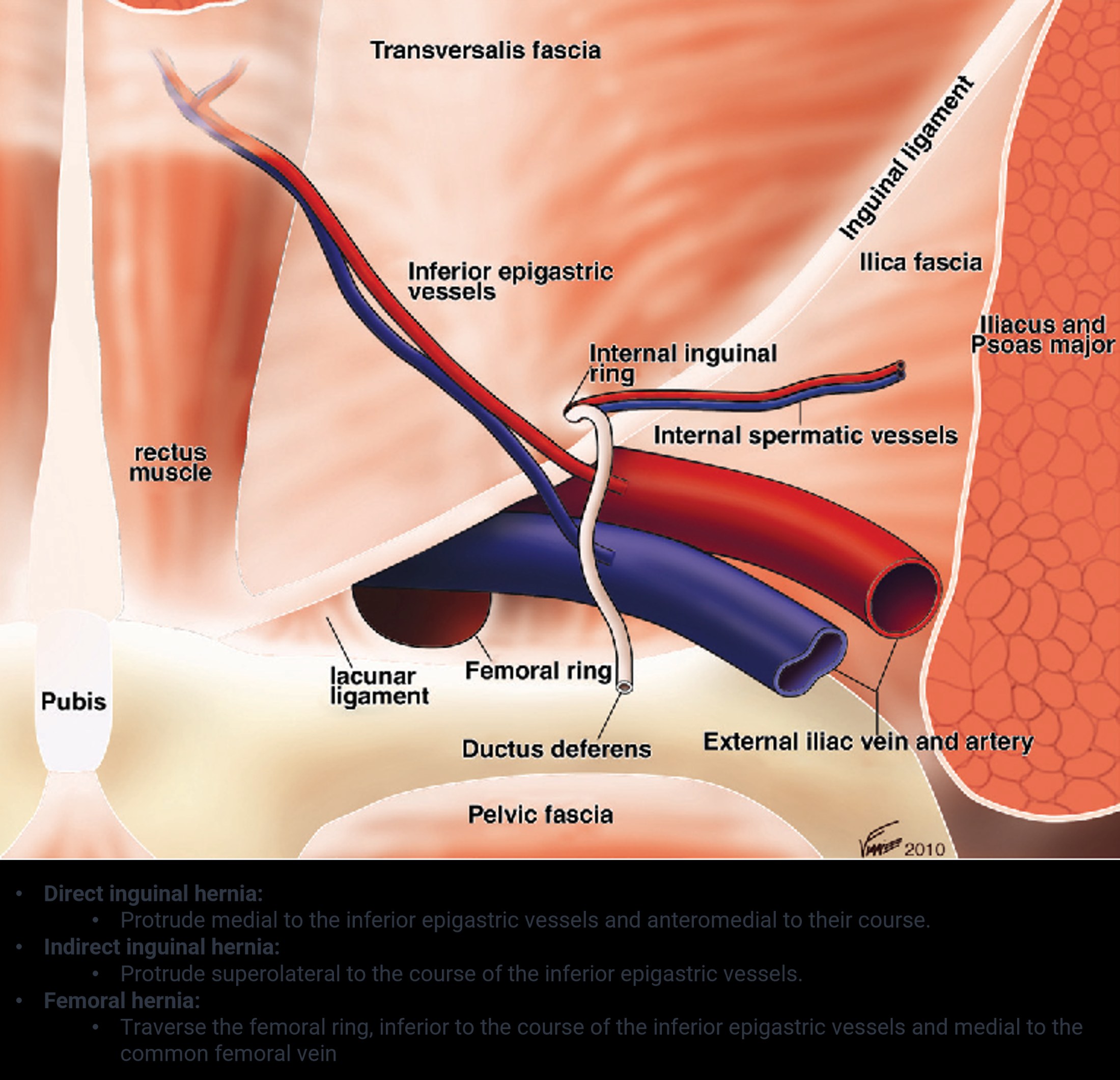 Hernias Compressed
