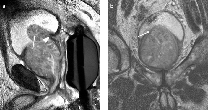 Figure 7. a, b. Sagittal T2-weighted image (a) of an 81-year-old male with type 5 BPH shows pedunculated enlargement (arrow) protruding into the bladder. Note that there is no displacement of trigon (arrowhead). Coronal T2-weighted image (b) shows bladder compression (arrow) inferiorly and bilateral marked BPH nodules.