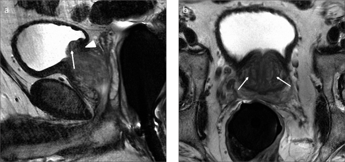 Figure 8. a, b. Sagittal T2-weighted image (a) of a 54-year-old male with type 5 BPH shows pedunculated enlargement (arrow) and superior displacement of trigon due to retrourethral enlargement (arrowhead). Axial T2-weighted image (b) shows bilateral transition zone enlargement with BPH nodules (arrows).