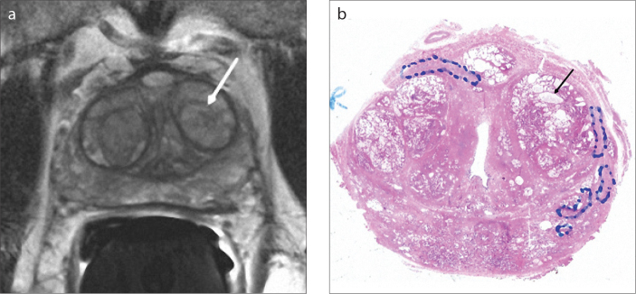 Figure 1. a, b. Axial T2-weighted image (a) of a 70-year-old male with type 3 BPH shows a predominantly hyperintense nodule (arrow) in the left transition zone. The pathology section (b) of this nodule is compatible with a mixed type BPH nodule consisting of mostly glandular components with markedly cystic glands (arrow).