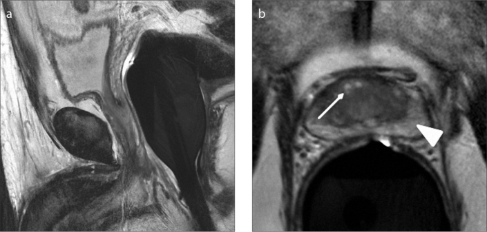 Figure 3. a, b. There is no marked prostatic enlargement on sagittal T2-weighted image (a) of a 43-year-old male with type 0 BPH. Axial T2-weighted image (b) shows mild heterogeneity (arrow) in the transition zone without any marked BPH nodules. Note that the peripheral zone (arrowhead) normally appears hyperintense on T2-weighted images.