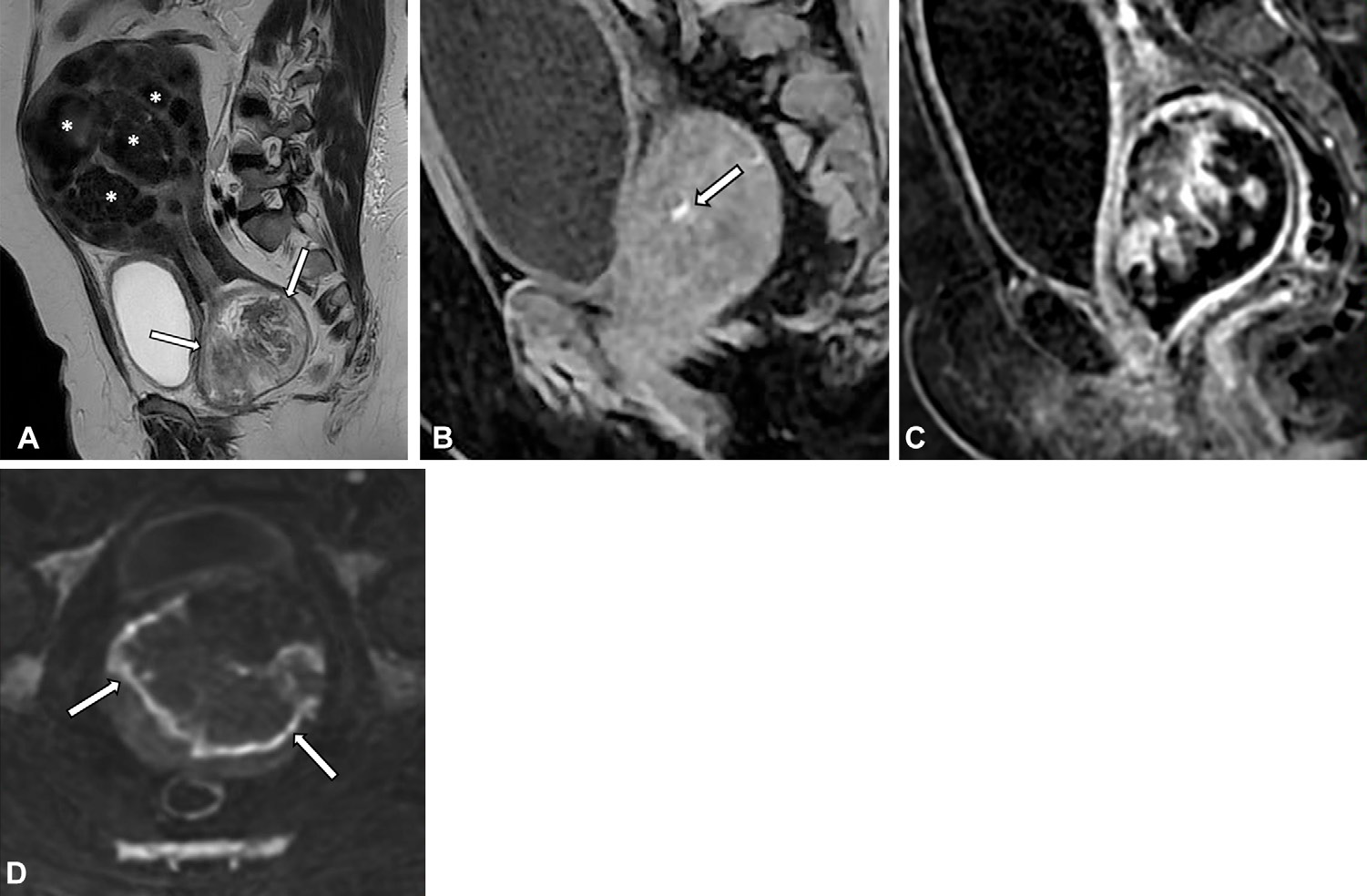 Figure 11. Atypical polypoid adenoma in a 50-year-old woman.
- (A) Sagittal T2-weighted MR image shows an enlarged uterus with multiple hypointense masses representing leiomyomas (*) and a polypoid lesion anchored in the lower uterine segment, protruding into the vagina (arrows).
- (B) Sagittal T1-weighted MR image with fat suppression shows a small hemorrhagic focus in the lesion (arrow).
- (C) Sagittal postcontrast MR image shows irregular areas of enhancement.
- (D) Diffusion- weighted MR image shows peripheral restriction (arrows).