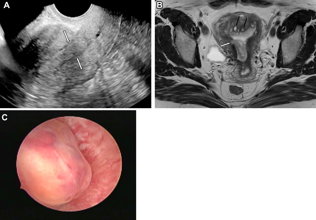 Figure 13. Polypoid adenomyoma in a 35-year-old woman.
- (A) Longitudinal endovaginal US image shows a polypoid lesion in the endometrial cavity (arrows).
- (B) Axial T2-weighted MR image shows that the lesion is anchored in the right uterine body wall with mild myometrial infiltration (white arrow) and contains a predominantly cystic component in its central portion. Uterine adenomyosis is also observed (black arrows).
- (C) Hysteroscopic view shows the lobulated surface of the polyp.
