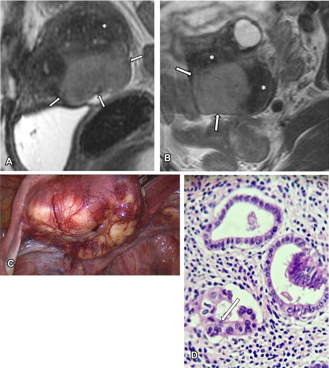 Figure 17. Endometrioid adenocarcinoma in a 52-year-old woman who was undergoing imaging follow-up for uterine adenomyosis. (A, B) Sagittal
- (A) and axial
- (B) T2-weighted MR images reveal a diffusely enlarged uterus with adenomyosis (*) and a lobulated mass of intermediate to high signal intensity located in the posterior uterine wall (arrows).
- (C) Laparoscopic view shows the mass.
- (D) Photomicrograph shows marked nuclear pleomorphism (arrow).