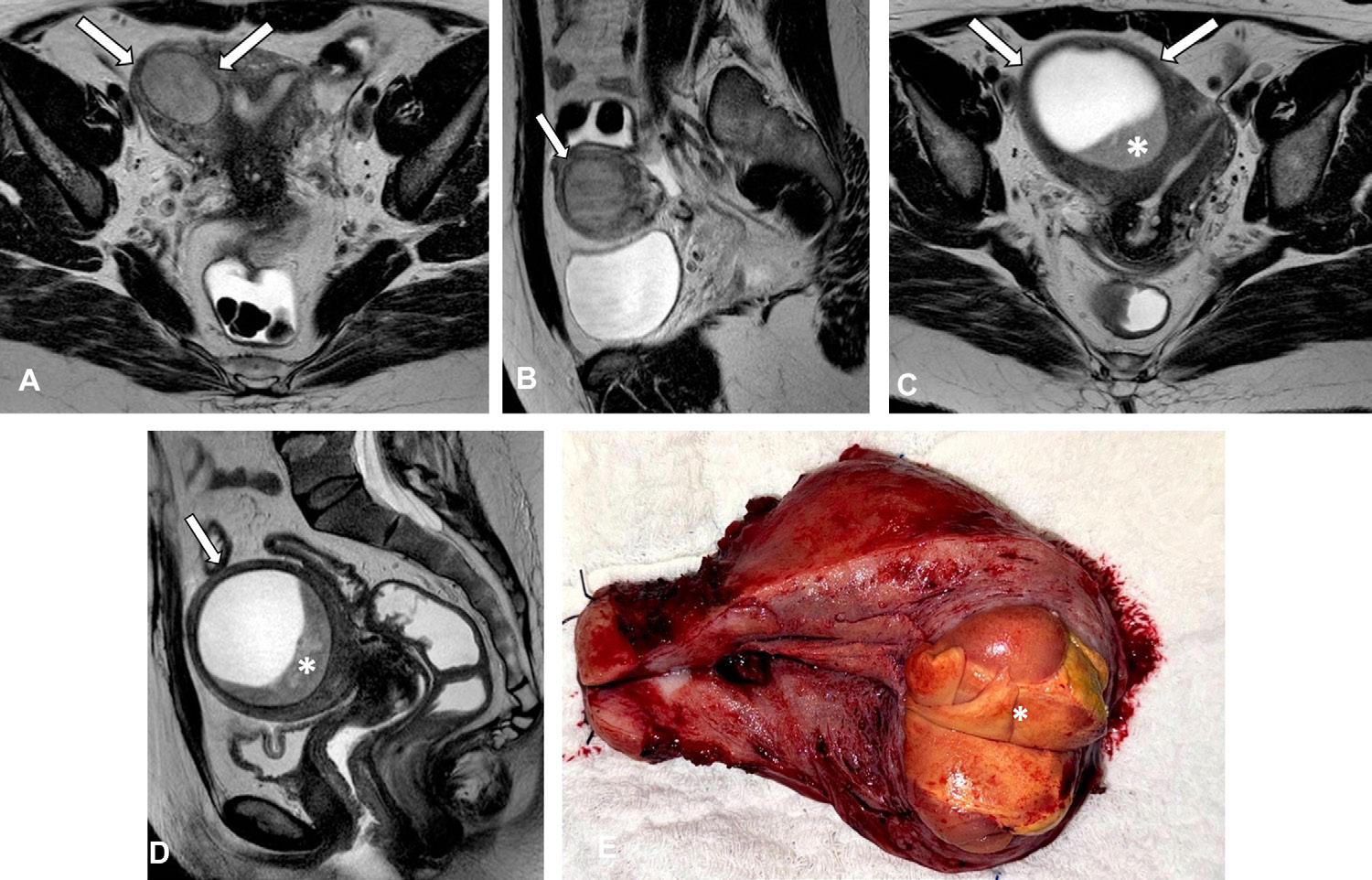 Figure 18. Adenomyosis in a 46-year-old woman with confirmed low-grade endometrial stromal sarcoma. (A, B) Axial
- (A) and sagittal
- (B) T2-weighted MR images show a large myometrial cystic mass abutting the uterine cavity (arrows). (C, D) Axial
- (C) and sagittal
- (D) T2-weighted MR images acquired 3 years later show substantial growth of the lesion (arrows), which exhibits prominent high signal intensity and a peripheral hypointense component (*) corresponding to solid areas or clots . The patient did not receive intravenous contrast material due to a history of allergy.
- (E) Photograph of the surgical specimen shows the mass (*).