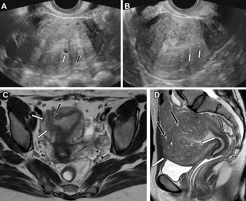 Figure 1. Endovaginal US and MRI features of typical adenomyosis in different patients who are in the menacme.
- (A) Transverse US image shows a myometrial cyst (white arrow) and a hyperechoic island (black arrow). Notice the fan-shaped shadowing.
- (B) Longitudinal US image shows echogenic lines (arrows).
- (C) Axial T2-weighted MR image shows a focal thickening of the JZ (white arrows), with embedded high-signal-intensity foci corresponding to ectopic glands (black arrow).
- (D) Sagittal T2-weighted MR image shows a diffusely enlarged uterus with thickening of the JZ (white arrows) and low signal intensity of the myometrium, with innumerable hyperintense foci (black arrows) scattered in the lesion.