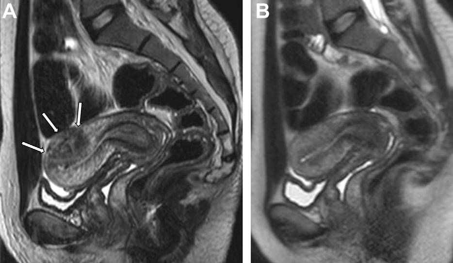 Figure 2. Physiologic transient myometrial contractions simulating adenomyosis in a 26-year-old woman.
- Sagittal T2-weighted MR images acquired a few minutes apart show a focal area of low signal intensity perpendicular to the JZ on the posterior uterine wall (arrows in A) that vanishes after a few minutes (B).