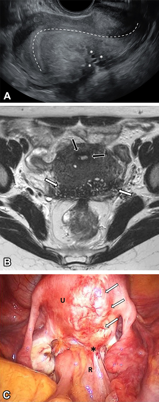 Figure 3. Deeply infiltrative endometriosis in two different women of reproductive age, both with severe dysmenorrhea.
- (A) Longitudinal US image shows a hypoechoic plaque lesion in the posterior uterine serosa, with small cystic areas infiltrating the myometrium (*) and causing uterine retractile retroflexion (dashed line).
- (B) Axial T2-weighted MR image shows a hypointense lesion in the posterior surface of the uterus, with multiple small hyperintense foci corresponding to endometrial glands (white arrows). The JZ appears normal (black arrows).
- (C) Laparoscopic view shows obliteration of the pouch of Douglas (*) with the rectum
- (R) tethered to the lesion (arrows) in the posterior aspect of the uterus (U). (Courtesy of Ricardo M. A. Pereira, MD.)