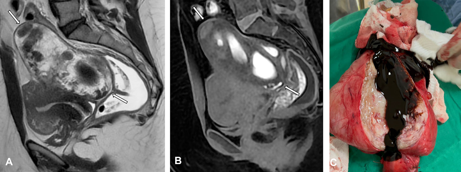 Figure 5. Subserosal adenomyoma in a 36-year-old woman with heavy menstrual cramps since adolescence that worsened in the last year.
- (A) Sagittal T2-weighted MR image shows a subserosal mass (arrows) in the posterior uterine wall, with heterogeneous signal intensity.
- (B) Sagittal T1-weighted MR image with fat saturation shows the mass (arrows) with areas of high signal intensity, indicating hemorrhagic content.
- (C) Photograph of gross specimen shows that it contains a large amount of chocolate-colored fluid.