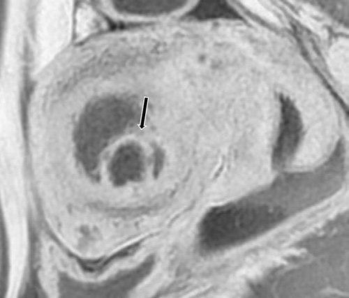 Figure 6. Submucosal cystic adenomyoma in a 45-year-old woman with infertility.
- Sagittal T2-weighted MR image show a round heterogeneous cystic lesion (arrow) distorting the uterine cavity.