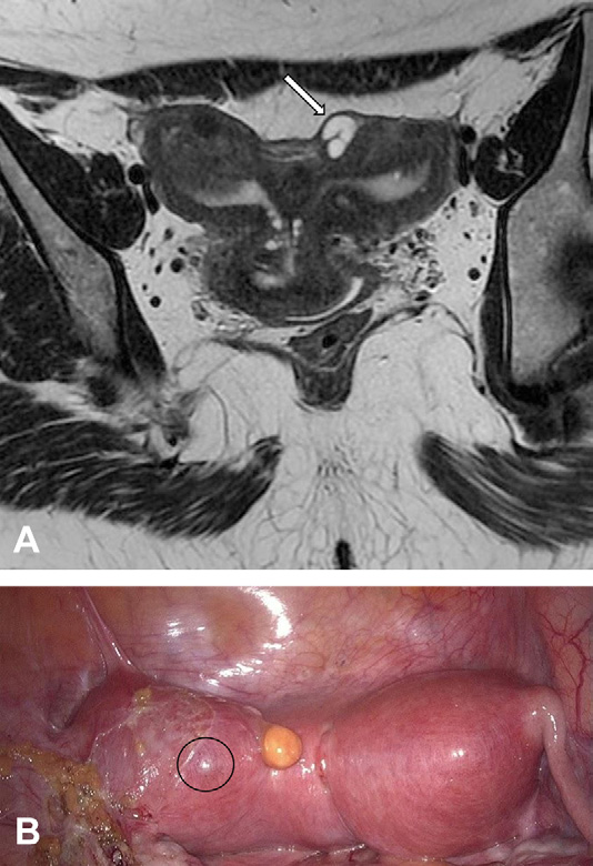 Figure 7. Cystic adenomyoma in a 42-year-old woman with Herlyn-Werner-Wunderlich syndrome.
- (A) Coronal T2-weighted MR image of the uterus shows a subserosal cystic lesion in the left hemiuterus (arrow).
- (B) Laparoscopic view shows the lesion (circle). (Courtesy of Ricardo M. A. Pereira, MD.)