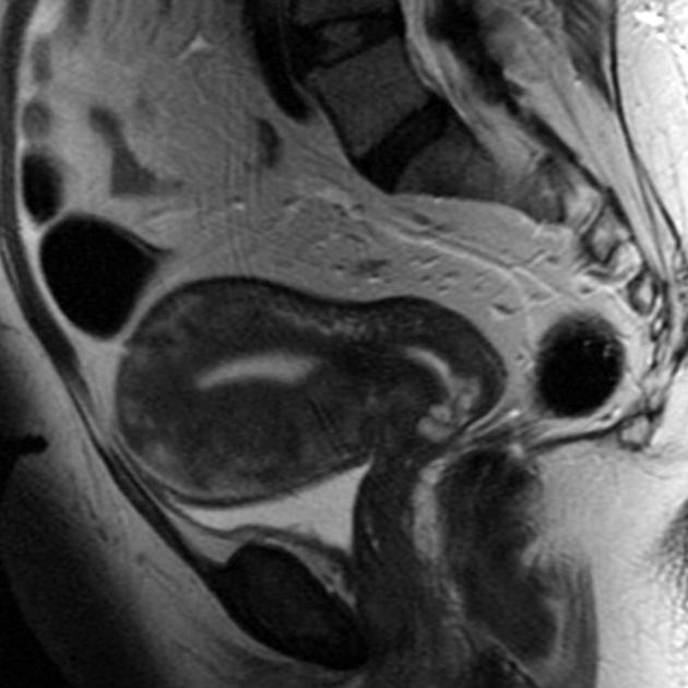 Adenomyosis 01