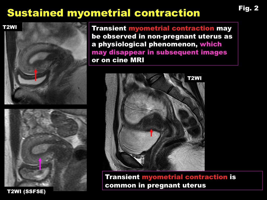 Transient physiological myometrial contraction