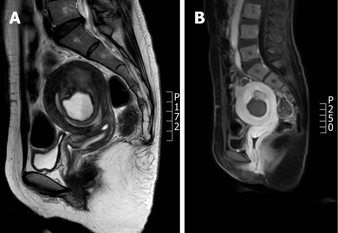 Magnetic resonance images of cystic adenomyosis (hyperintensity in T1 weighted image, moderate to high intensity in T2 weighted image, and low intensity in the edge). A: Case 1; B: Case 2.