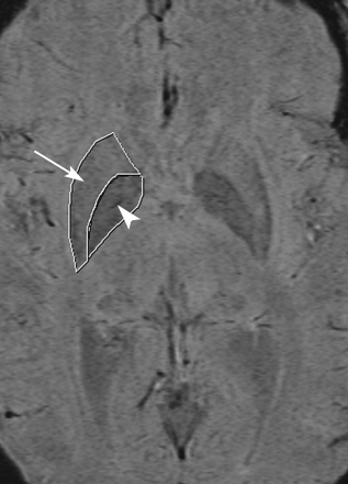 region of interest drawn around the putamen (arrow) and globus pallidus (arrowhead)