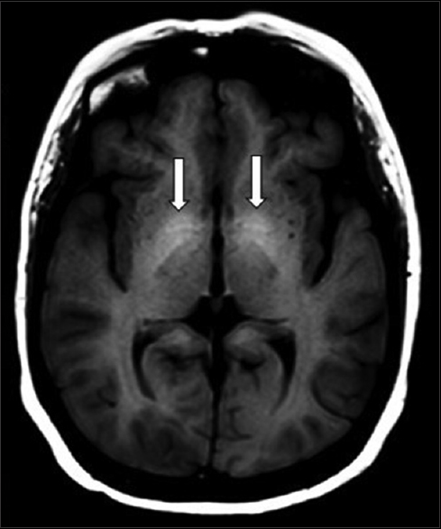 Manganese Elevated in hemodialysis patients