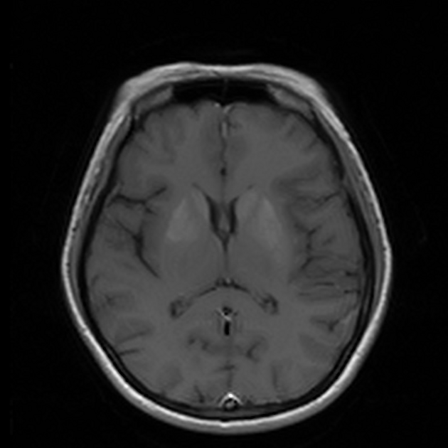Non-ketotic hyperglycemic hemichorea