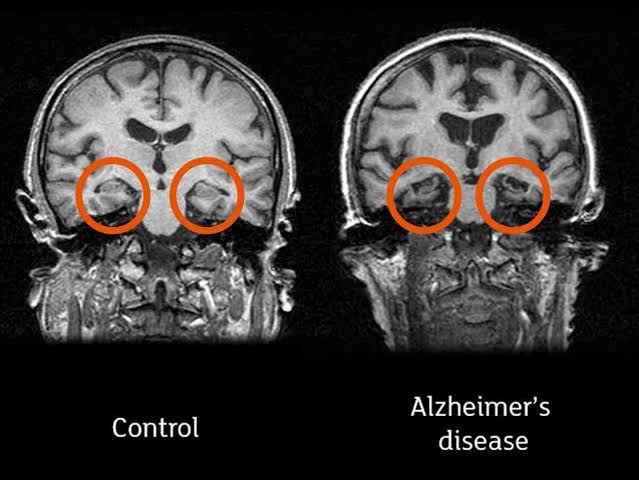 Hippocampal atrophy control comparison