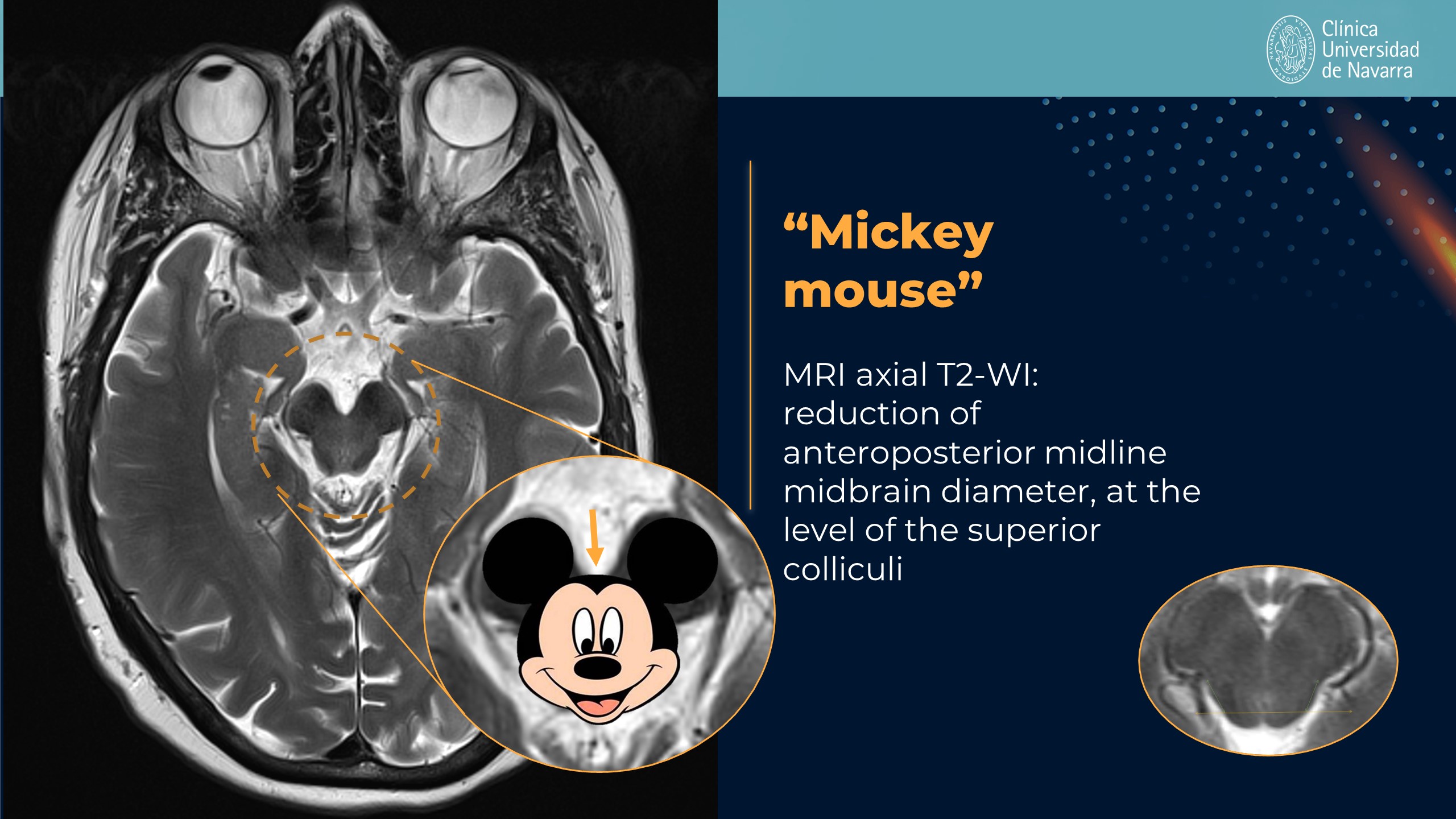 Axial T2 MRI illustration of the Mickey mouse sign in PSP