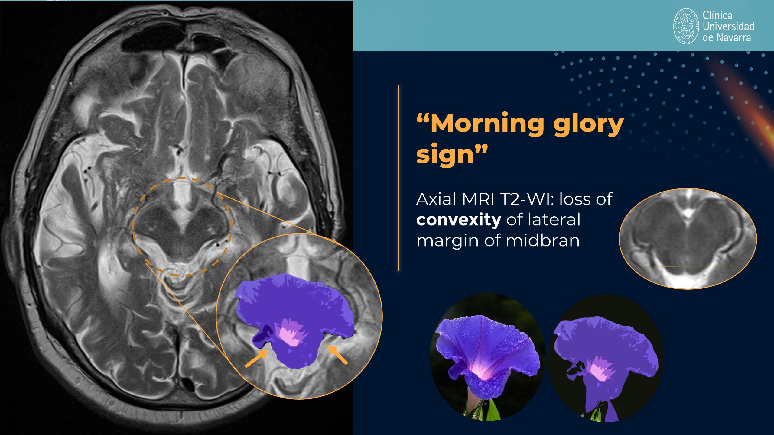Axial T2 MRI illustration of the morning glory sign in PSP
