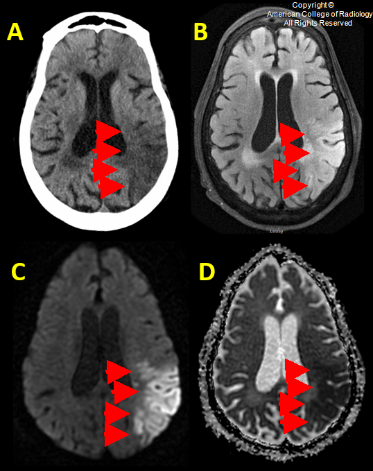MRI 



Slices show a wedge-shaped region of relative hypoattenuation and gray-white matter obscuration involving the left temporoparietal region (arrows) on non-contrast CT 



(A) with corresponding hyperintense signal (arrows) on FLAIR MR 



(B) and DWI MR 



(C) images and dark signal (low values — red arrows) on the ADC MRI map 



(D), consistent with acute ischemic infarction involving the left MCA M2 territory.
