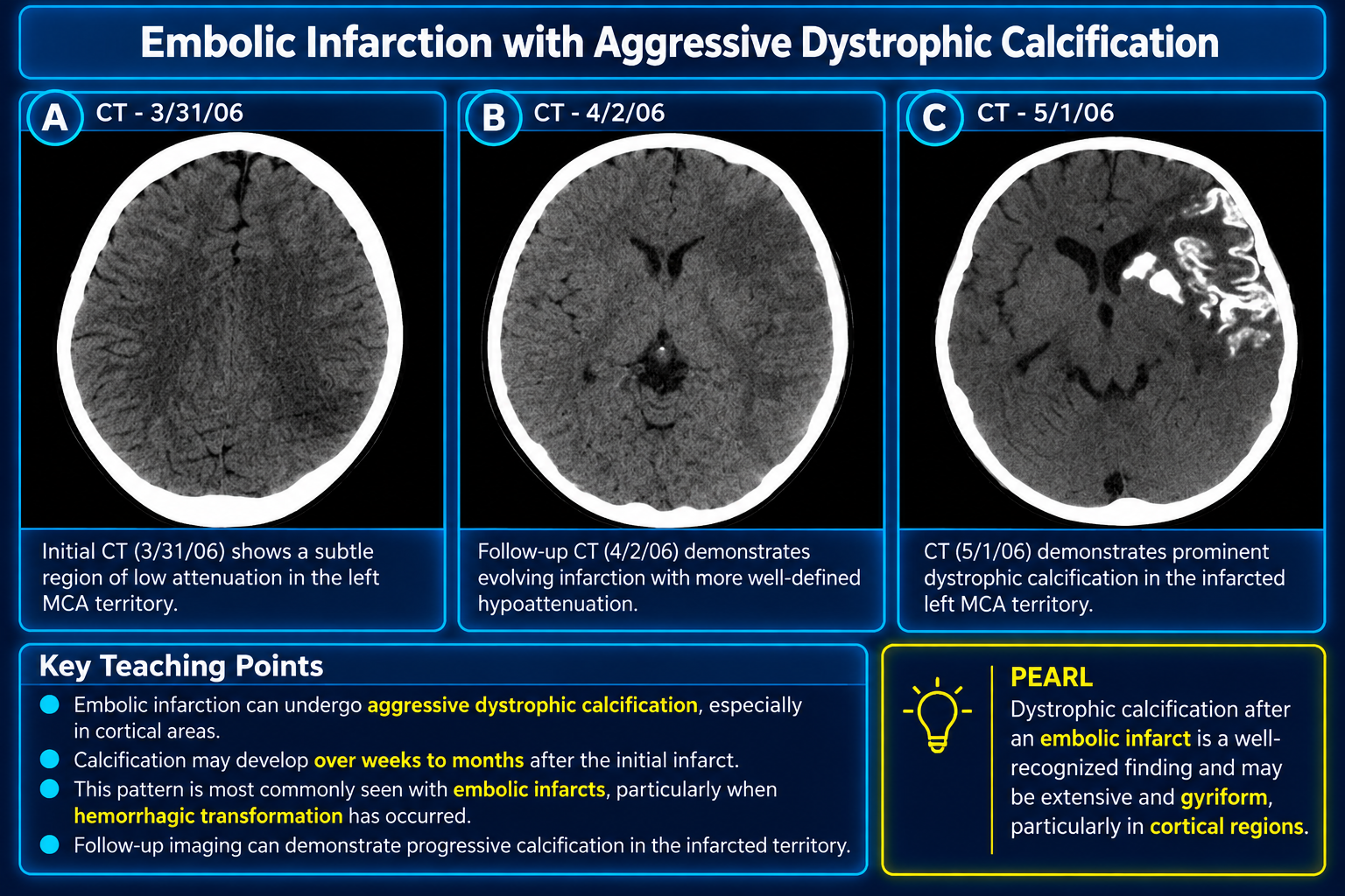 Serial CT images showing an evolving left MCA infarct followed by extensive gyriform dystrophic calcification