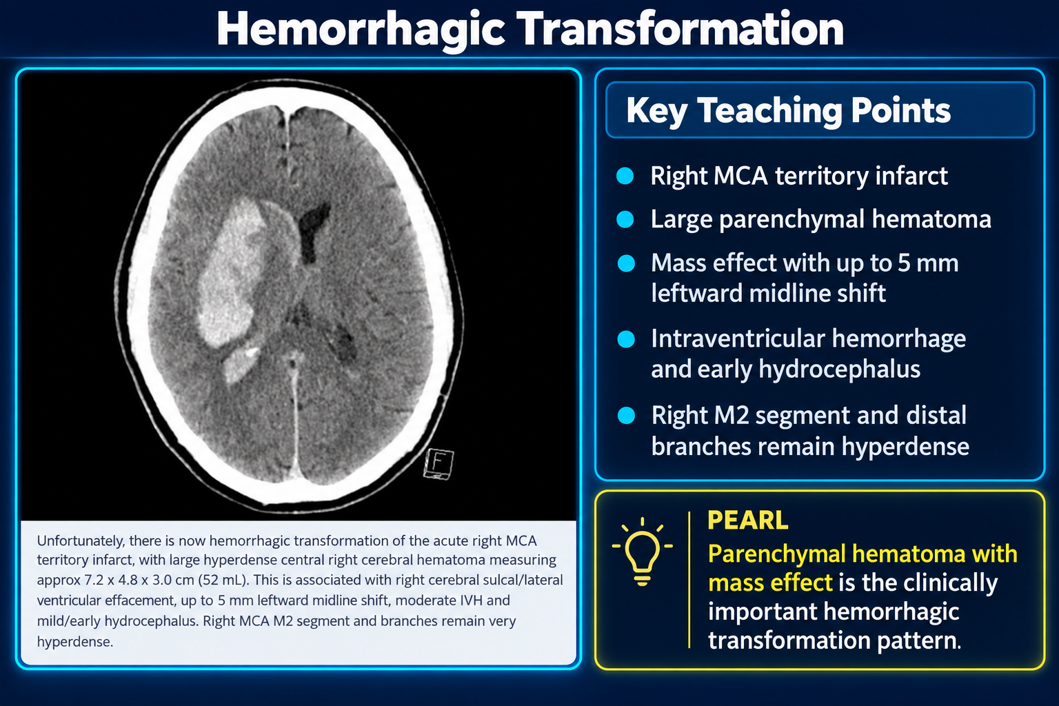 Teaching graphic showing hemorrhagic transformation of a right MCA infarct with a large parenchymal hematoma, mass effect, intraventricular hemorrhage, and early hydrocephalus
