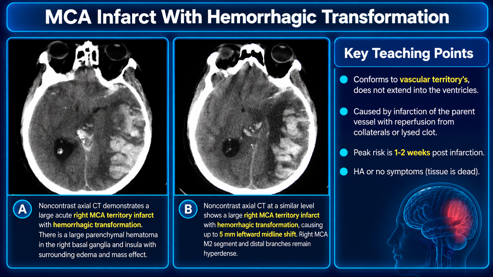 Teaching graphic showing hemorrhagic transformation of a right MCA infarct with a large parenchymal hematoma, mass effect, intraventricular hemorrhage, and early hydrocephalus