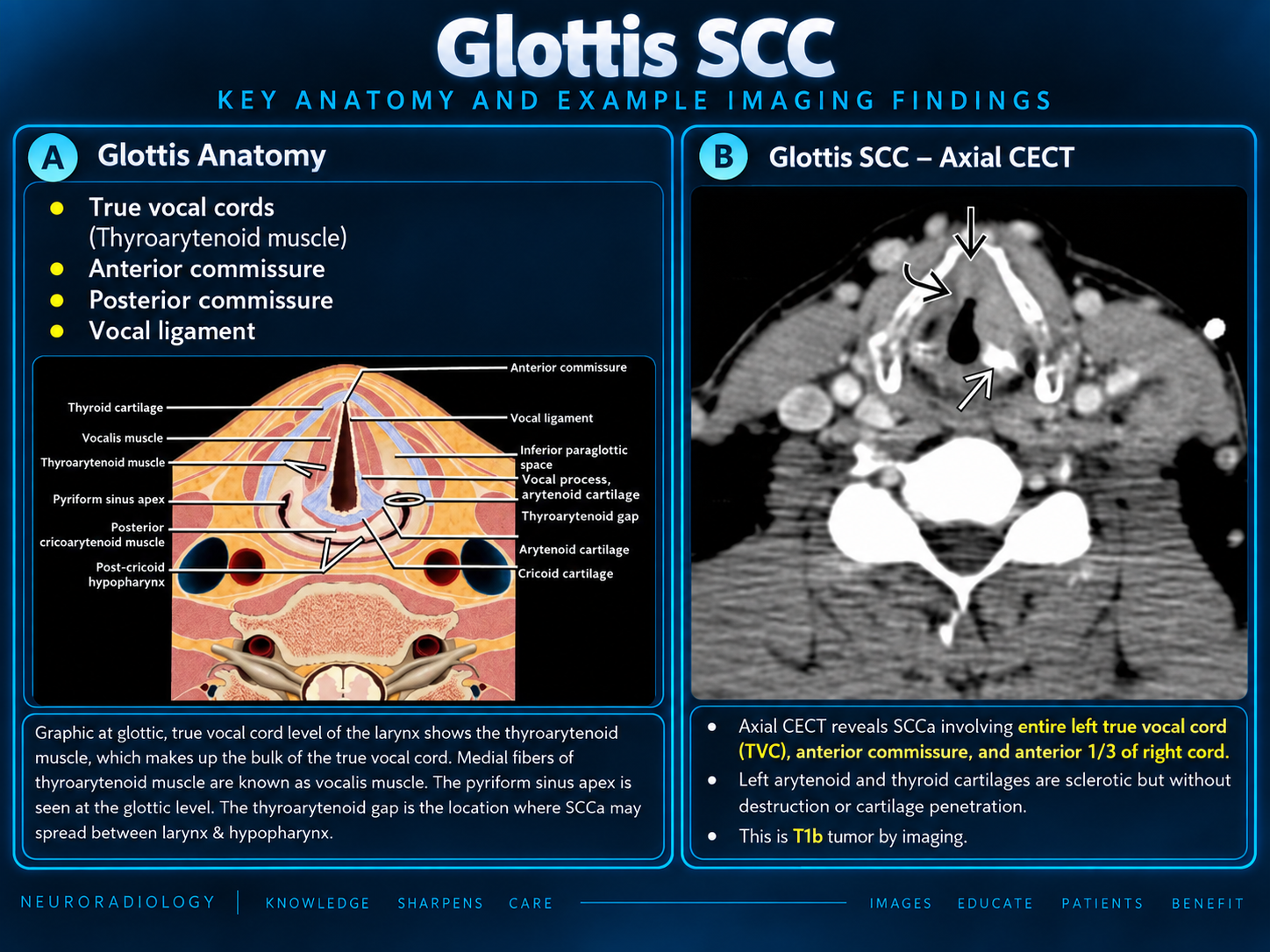 Glottic anatomy and axial CT example of glottic SCC