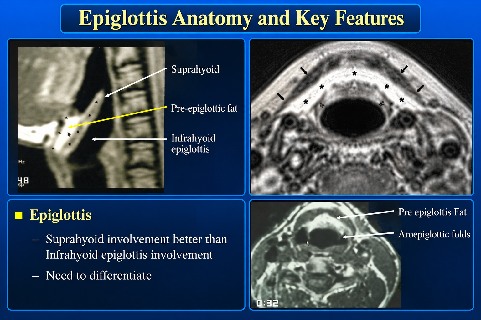 Epiglottis anatomy and key imaging features