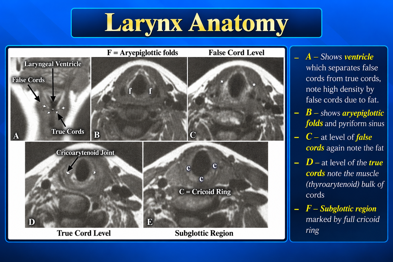 Axial laryngeal levels from aryepiglottic folds to subglottis