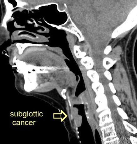 Sagittal CT showing subglottic cancer