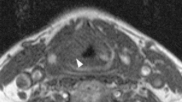 Axial MRI example of a supraglottic lesion