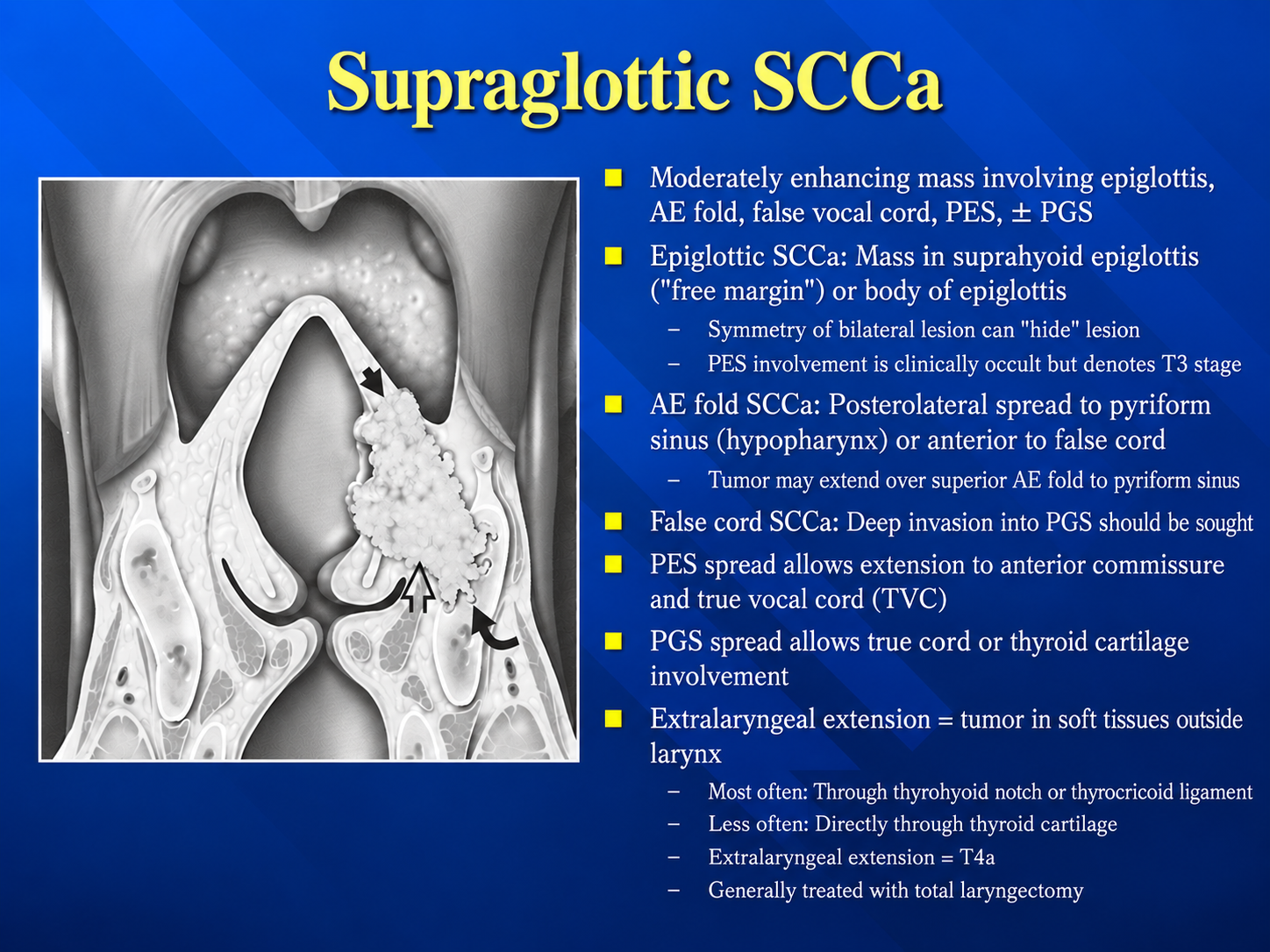 Supraglottic SCC routes of spread