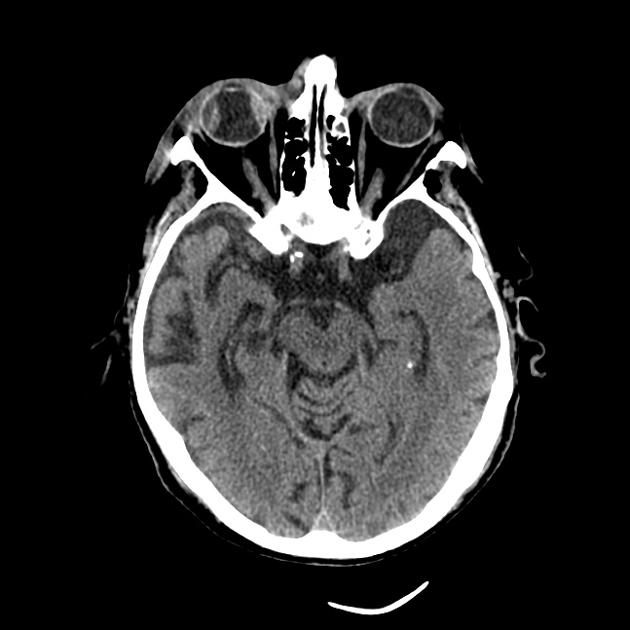 Hemorrhagic Choroidal detachment - traumatic