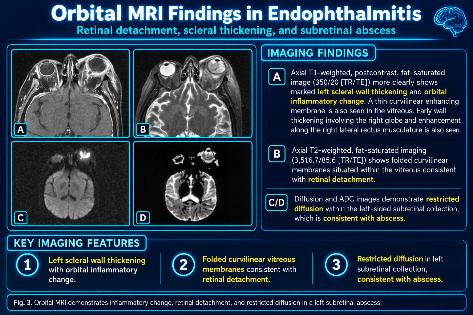 Orbital MRI findings in endophthalmitis