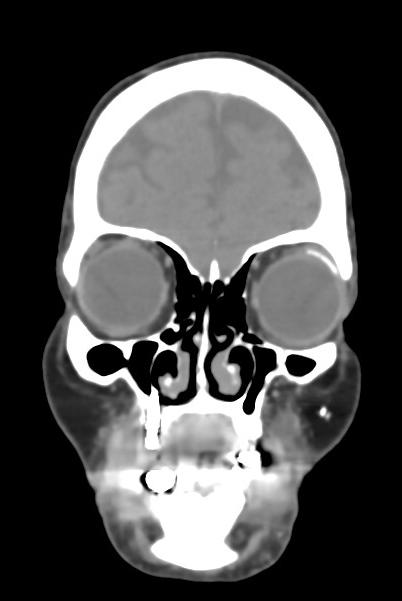 Macrophthalmia due to glaucoma

Bilateral symmetric macrophthalmia. History of bilateral glaucoma, after implantation of an Ahmed glaucoma valve in the left eye and more recently Descemet's stripping