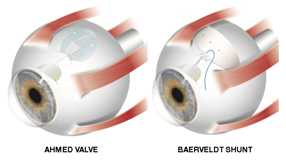 Glaucoma Valeves