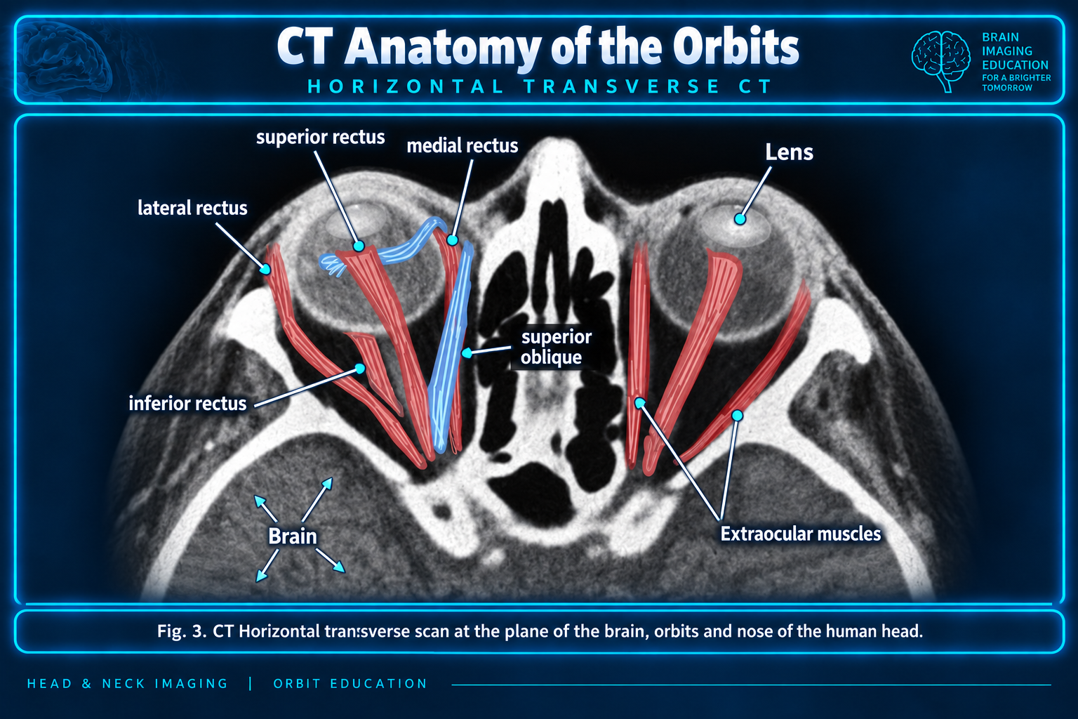 Axial CT extraocular muscle anatomy