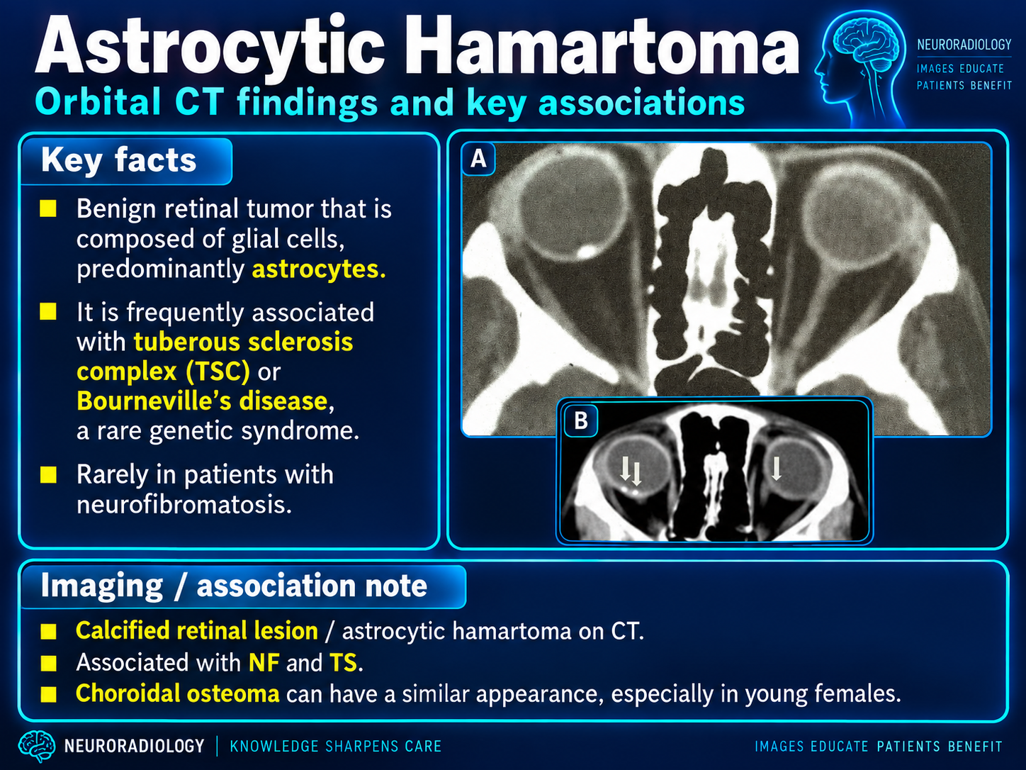 Orbital CT findings and key associations of an astrocytic hamartoma