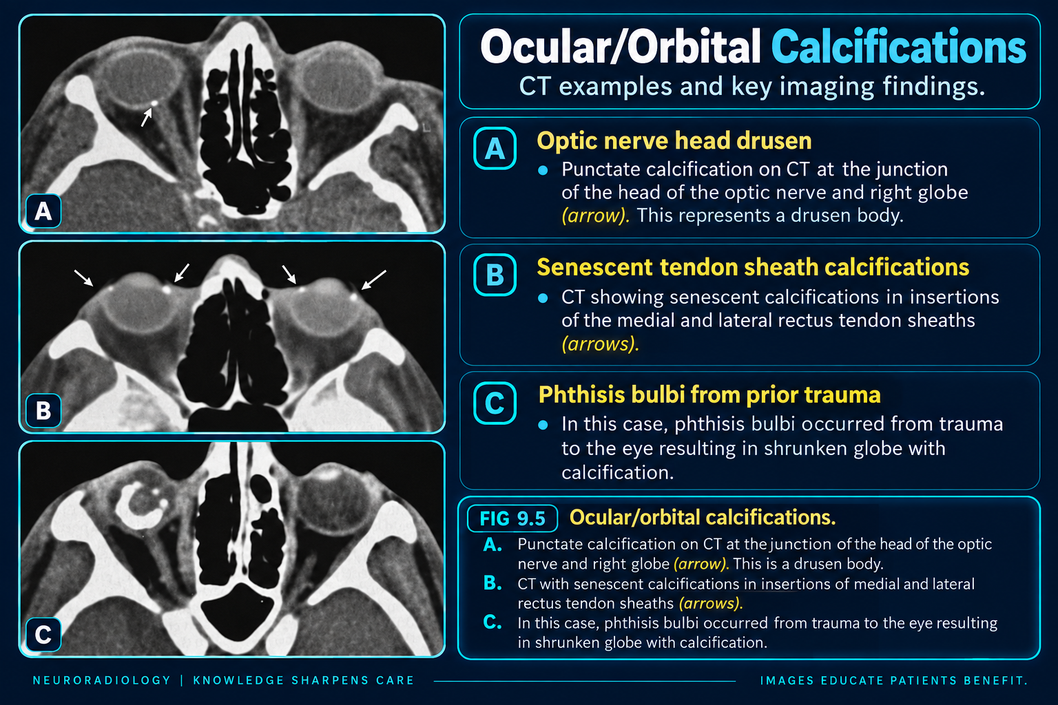 CT examples of optic disc drusen, tendon insertion calcifications, and phthisis bulbi