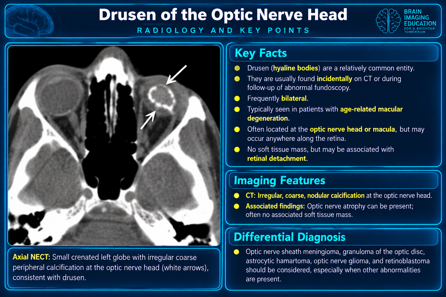 CT appearance and key facts for optic nerve head drusen