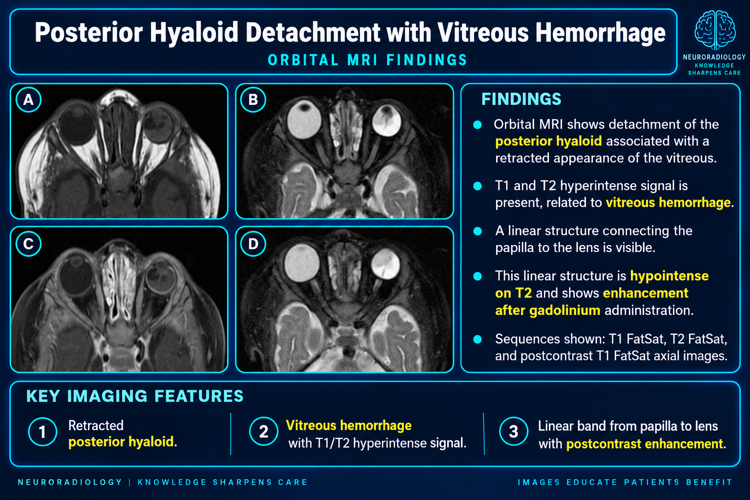 Posterior vitreous detachment
